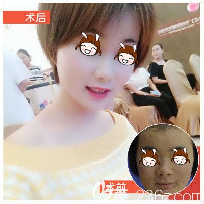 壹加壹清痘术前术后对比图 壹加壹清痘术前术后对比图