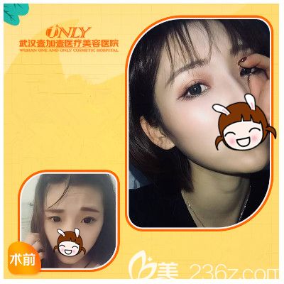 壹加壹做精切双眼皮术后恢复效果 壹加壹做精切双眼皮术后恢复效果