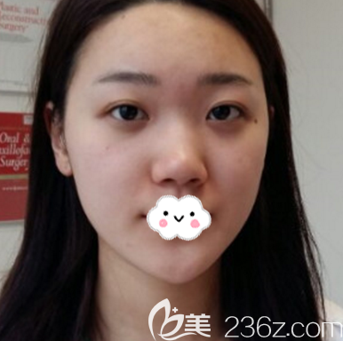 在东莞西妃做隆鼻术前照片 在东莞西妃做隆鼻术前照片