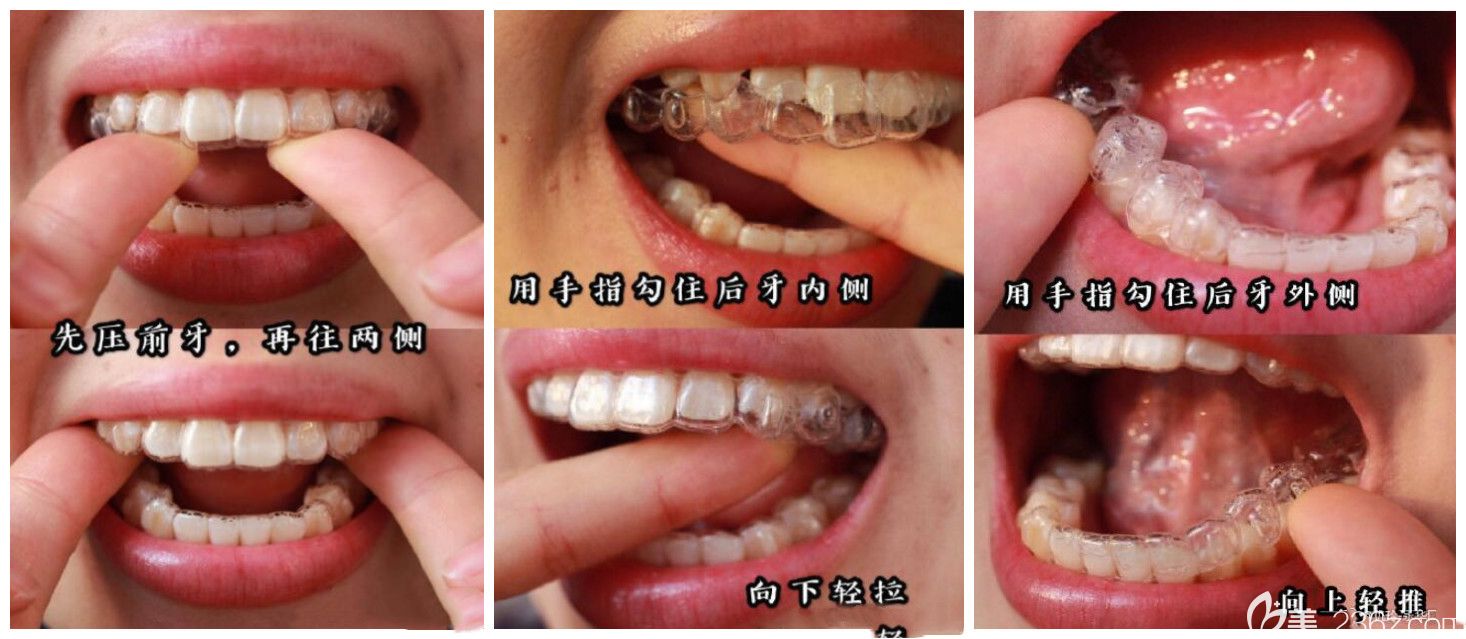 上海永华口腔医生告诉大家隐形牙套正确摘戴方法 上海永华口腔医生告诉大家隐形牙套正确摘戴方法
