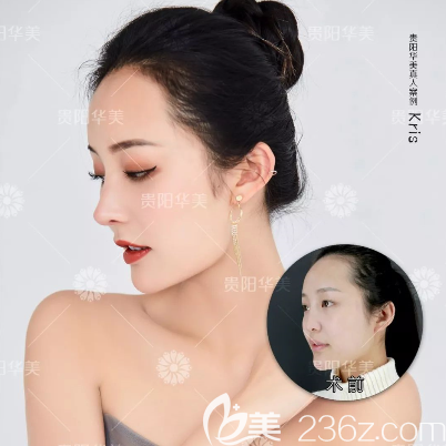 贵阳华美隆鼻好不好 贵阳华美隆鼻好不好