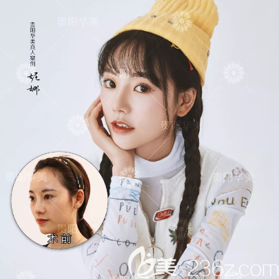 贵州哪个医院隆鼻好 贵州哪个医院隆鼻好