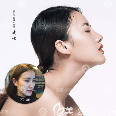 贵州华美隆鼻案例 贵州华美隆鼻案例