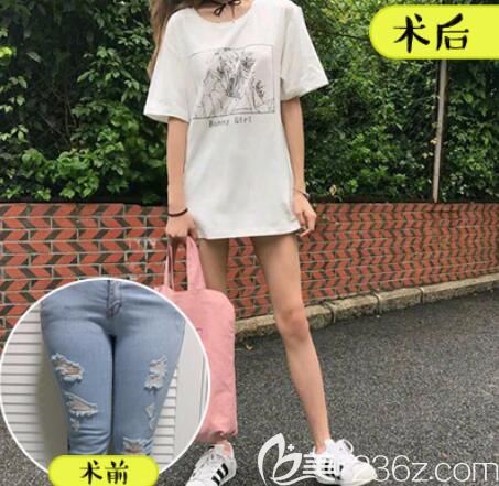 壹加壹李杰注射瘦腿案例前后效果对比 壹加壹李杰注射瘦腿案例前后效果对比