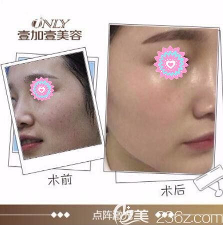 点阵极光祛斑有效果吗?壹加壹极光祛斑案例供参考 点阵极光祛斑有效果吗?壹加壹极光祛斑案例供参考