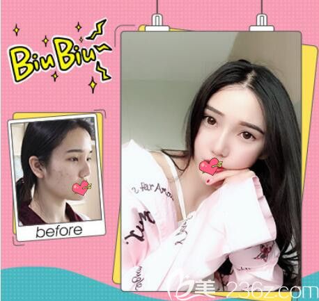 芜湖壹加壹好不好?壹加壹雷中元肋软骨隆鼻案例来验证 芜湖壹加壹好不好?壹加壹雷中元肋软骨隆鼻案例来验证