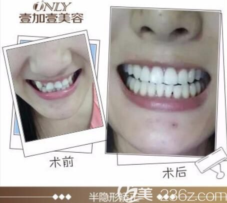 芜湖哪里牙齿矫正好?壹加壹半隐形牙齿矫正案例前后效果对比 芜湖哪里牙齿矫正好?壹加壹半隐形牙齿矫正案例前后效果对比