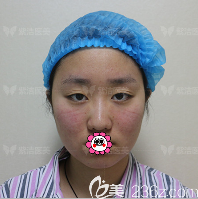 我在北京紫洁俪方医疗美容做定点双眼皮前样子 我在北京紫洁俪方医疗美容做定点双眼皮前样子