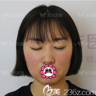 张金娥医生给我做定点双眼皮第5天样子 张金娥医生给我做定点双眼皮第5天样子