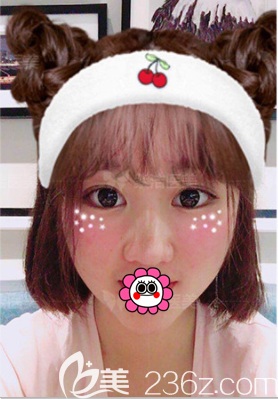 北京紫洁医美定点双眼皮案例 北京紫洁医美定点双眼皮案例