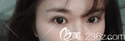 周其光医生在医院坐诊了,看我找周其光割双眼皮后恢复的怎么样,效果好吗