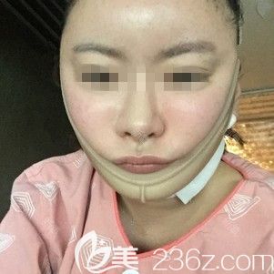 在韩国ARTLINE做面部吸手术当天 在韩国ARTLINE做面部吸手术当天