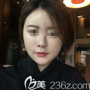 在韩国ARTLINE做面部吸术后2周 在韩国ARTLINE做面部吸术后2周