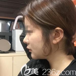 在韩国ARTLINE做面部吸术后1个月 在韩国ARTLINE做面部吸术后1个月