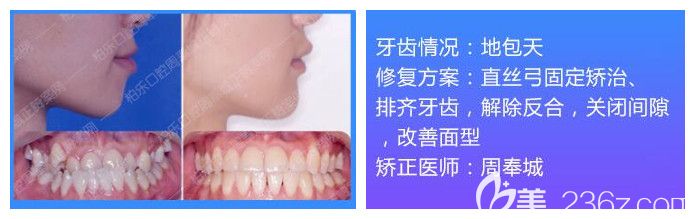 南宁柏乐口腔牙齿矫正案例 南宁柏乐口腔牙齿矫正案例