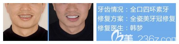 南宁柏乐口腔牙齿美白案例 南宁柏乐口腔牙齿美白案例