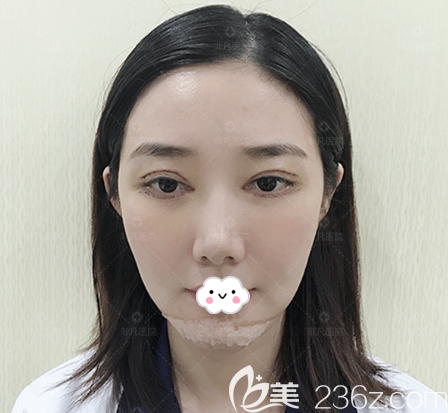 深圳非凡王天成双眼皮修复术后3天