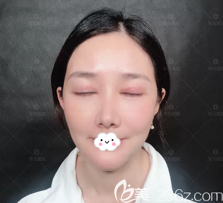 王天成院长双眼皮修复7天拆线效果