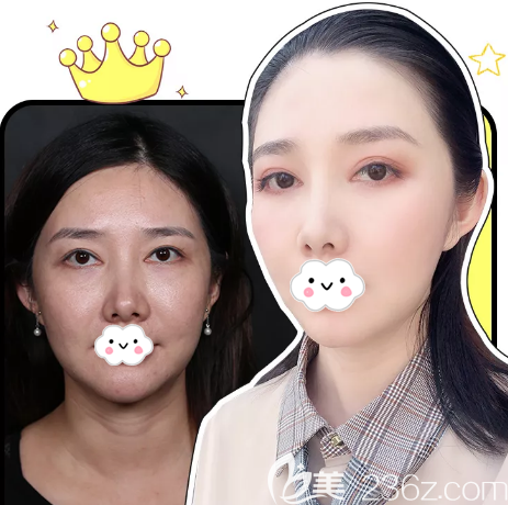 深圳非凡王天成做的双眼皮修复案例对比图