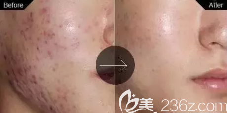 达州双均祛痘治疗前后对比效果