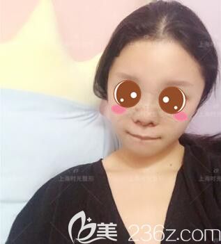上海时光马杰假体隆鼻真人案例术后第5天