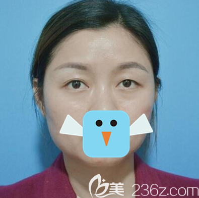 双眼皮手术失败术后大小眼 双眼皮手术失败术后大小眼