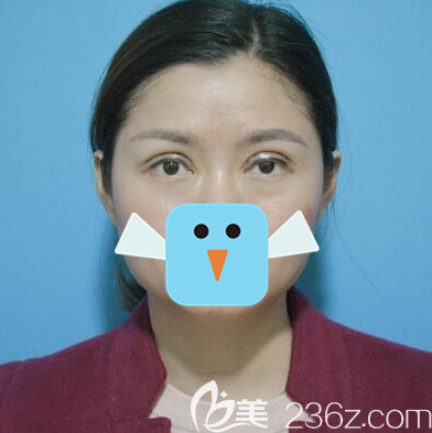 四川双均李隆才眼修复术后即刻 四川双均李隆才眼修复术后即刻