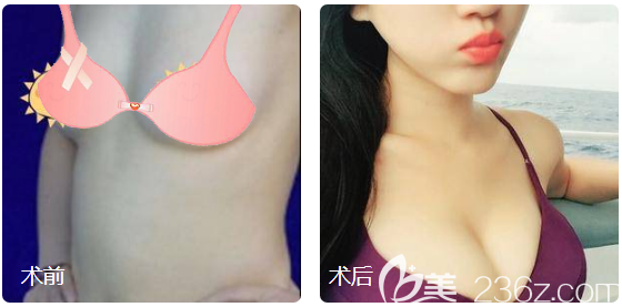 广州星团医美赵辉隆胸案例前后对比图 广州星团医美赵辉隆胸案例前后对比图