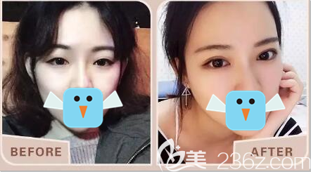 四川双均双眼皮效果展示