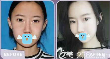 四川双均隆鼻术前术后对比照片