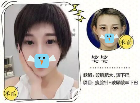 达州双均瘦脸+玻尿酸丰下巴术后效果