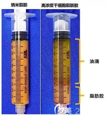 苏州紫馨拥有脂肪胶填充技术成活率高 苏州紫馨拥有脂肪胶填充技术成活率高