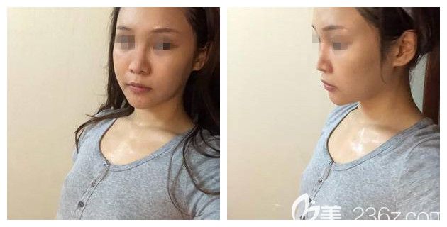 面诊苏州紫馨术前面颊凹陷 面诊苏州紫馨术前面颊凹陷