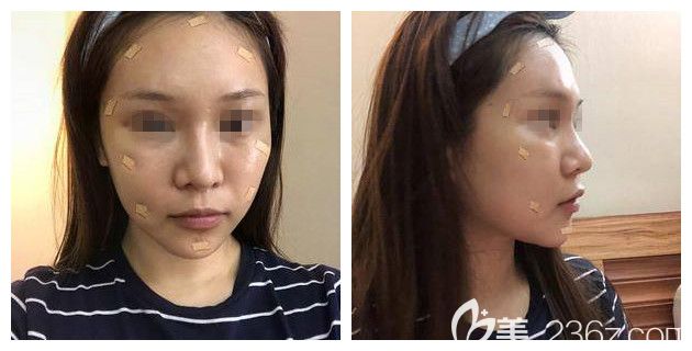 刚做完自体脂肪细胞胶填充面部术后即刻 刚做完自体脂肪细胞胶填充面部术后即刻