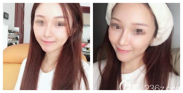 术后一周面部填充自体脂肪细胞胶效果 术后一周面部填充自体脂肪细胞胶效果