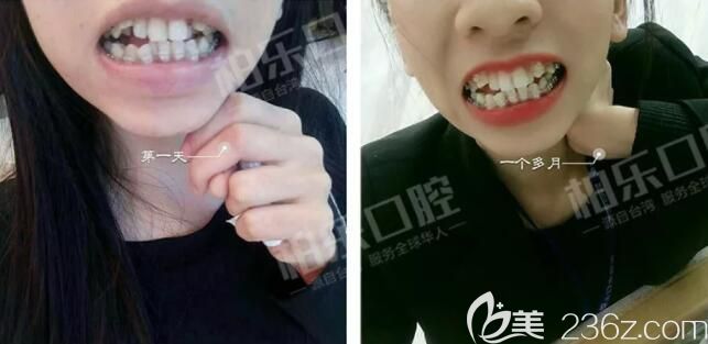 我在南宁柏乐口腔刚开始做牙齿矫正 我在南宁柏乐口腔刚开始做牙齿矫正