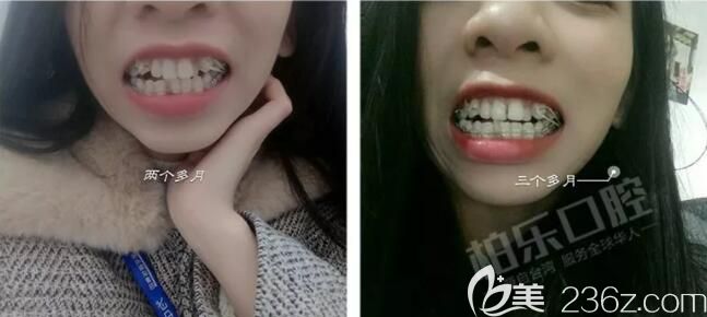 我在南宁柏乐口腔做半隐形牙齿矫正3个月效果 我在南宁柏乐口腔做半隐形牙齿矫正3个月效果