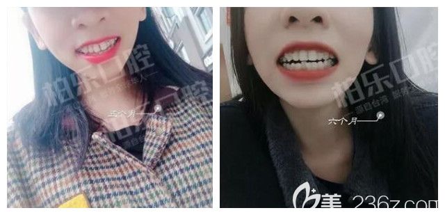我在南宁柏乐口腔做半隐形陶瓷托槽牙齿矫正6个月 我在南宁柏乐口腔做半隐形陶瓷托槽牙齿矫正6个月
