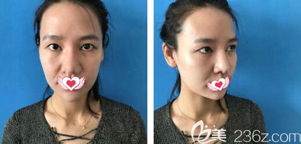 在<!--<i data=20240703-sp></i>-->割双眼皮手术前 在<!--<i data=20240703-sp></i>-->割双眼皮手术前