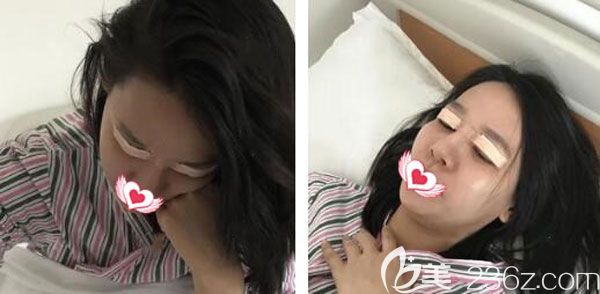 切开双眼皮术后没有渗血 切开双眼皮术后没有渗血