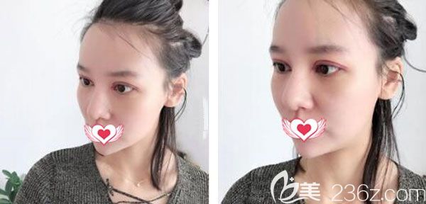 割双眼皮术后第7天拆线线条流畅 割双眼皮术后第7天拆线线条流畅