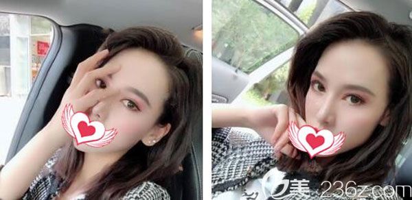 找陈茂年做综合双眼皮20天后,又做了玻尿酸填充泪沟,看效果是这样的