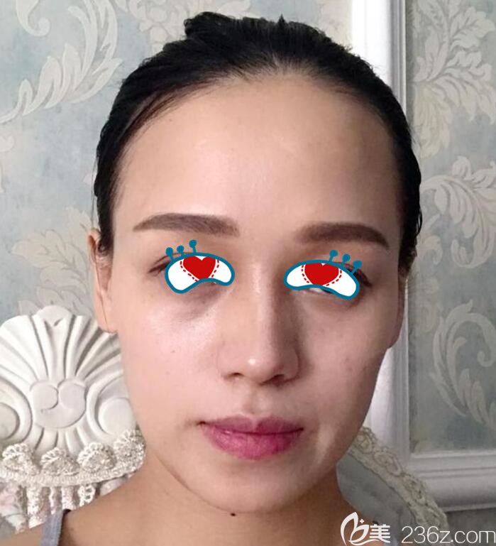 去合肥壹美尚做做自体脂肪填充之前 去合肥壹美尚做做自体脂肪填充之前