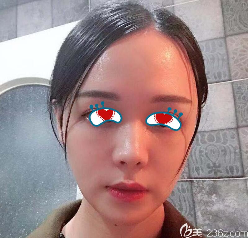 <!--<i data=20240703-sp></i>-->做面部自体脂肪填充术后第7天 <!--<i data=20240703-sp></i>-->做面部自体脂肪填充术后第7天