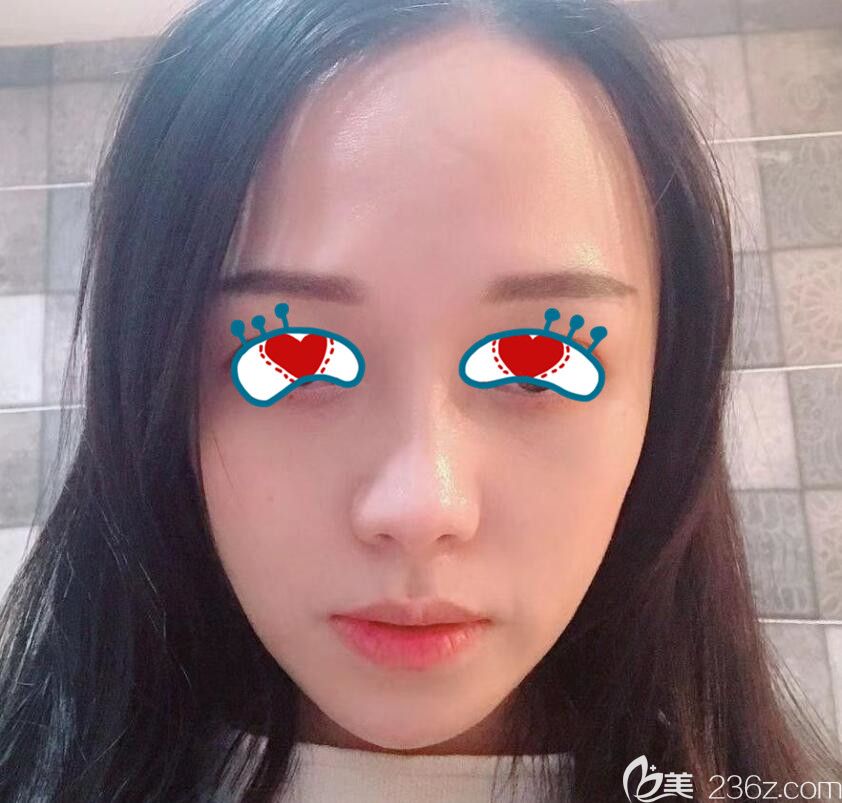 合肥壹美尚整形自体脂肪面部填充术后15天恢复情况 合肥壹美尚整形自体脂肪面部填充术后15天恢复情况