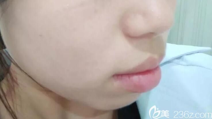 嘴凸龅牙矫正前侧面图