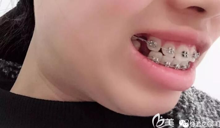 在永华口腔拔牙矫正天