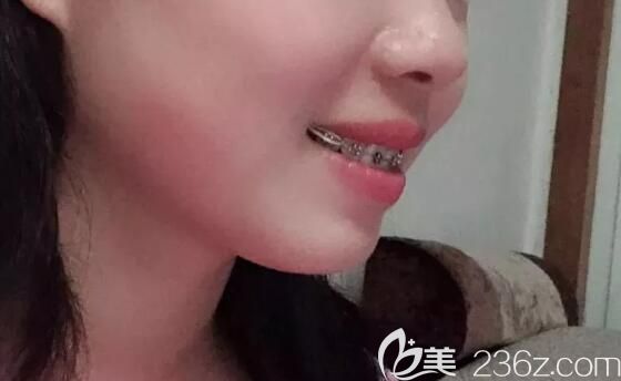 永华口腔戴钢牙套9个月侧脸照片