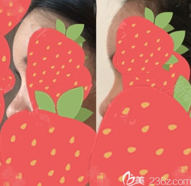 韩国ACE脂肪修复Lipolis针到底怎么样 韩国ACE脂肪修复Lipolis针到底怎么样