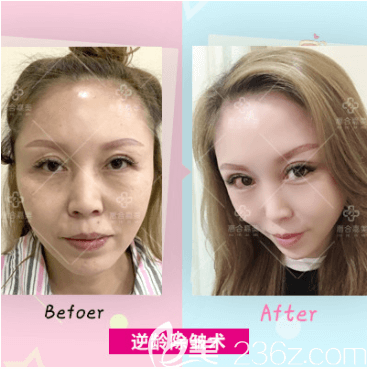 北京惠合嘉美<!--<i data=20240703-sp></li>
<li><i data=20240703-sp></i>-->医生面部小切口提升除皱术案例